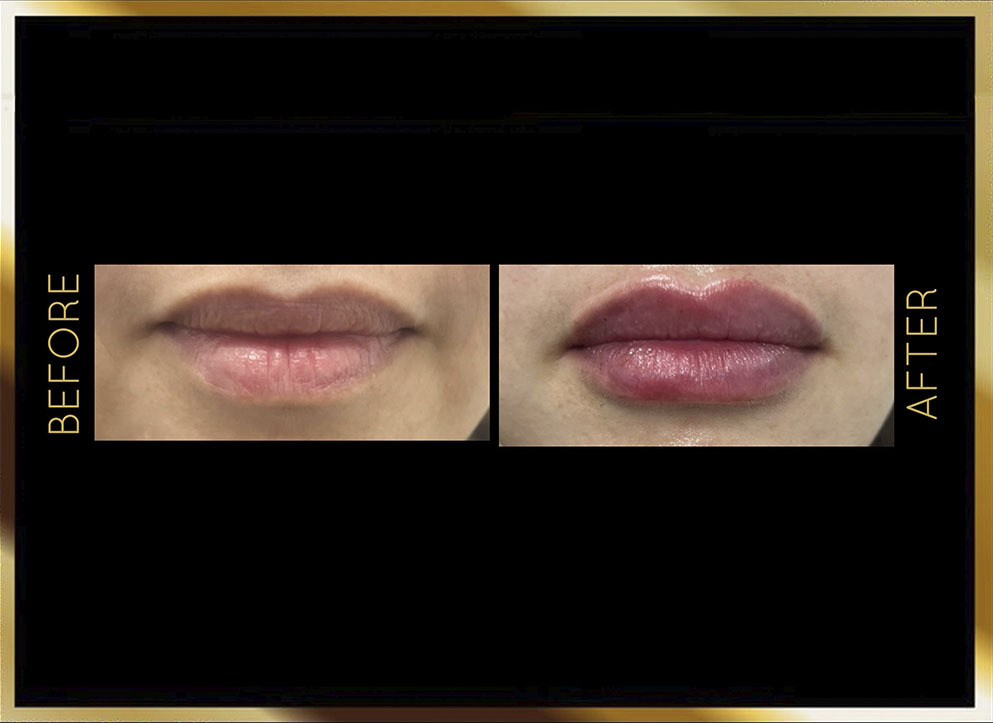 Lip Filler Before and After NYC Case-1 Front