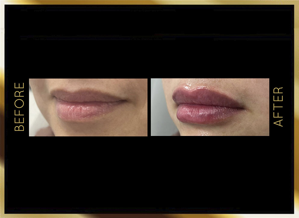 Lip Filler Before and After NYC Case-1 Front