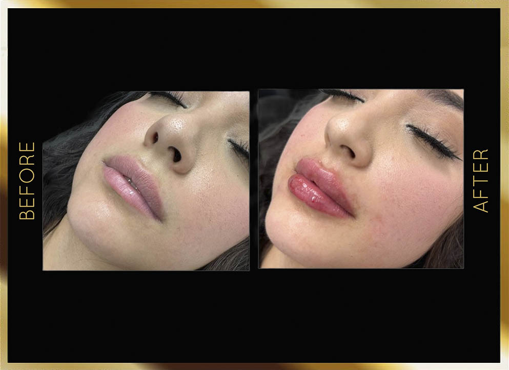 Lip Filler Before and After NYC Case-1 Front