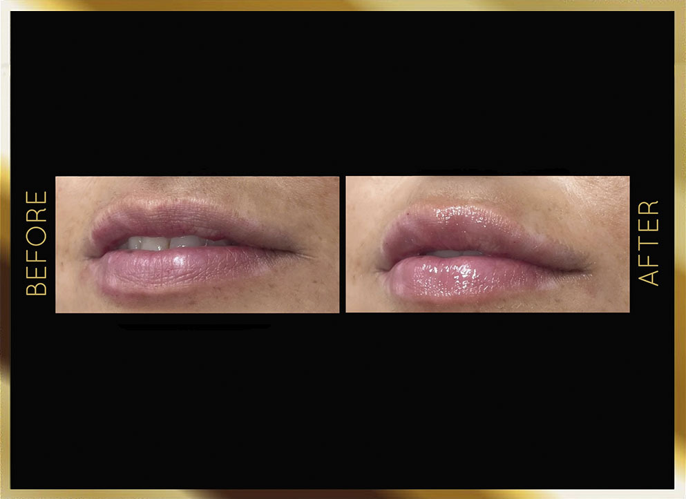 Lip Filler Before and After NYC Case-1 Front