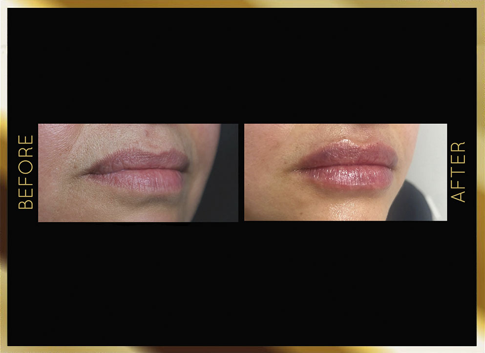 Lip Filler Before and After NYC Case-1 Front