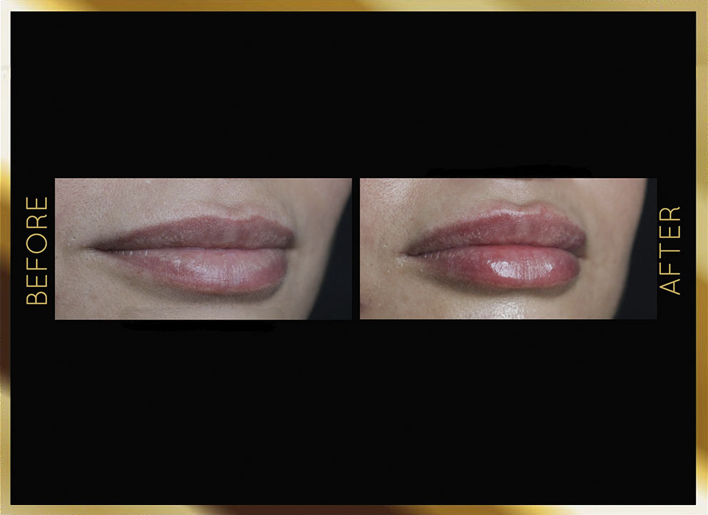 Lip Filler Before and After NYC Case-1 Front