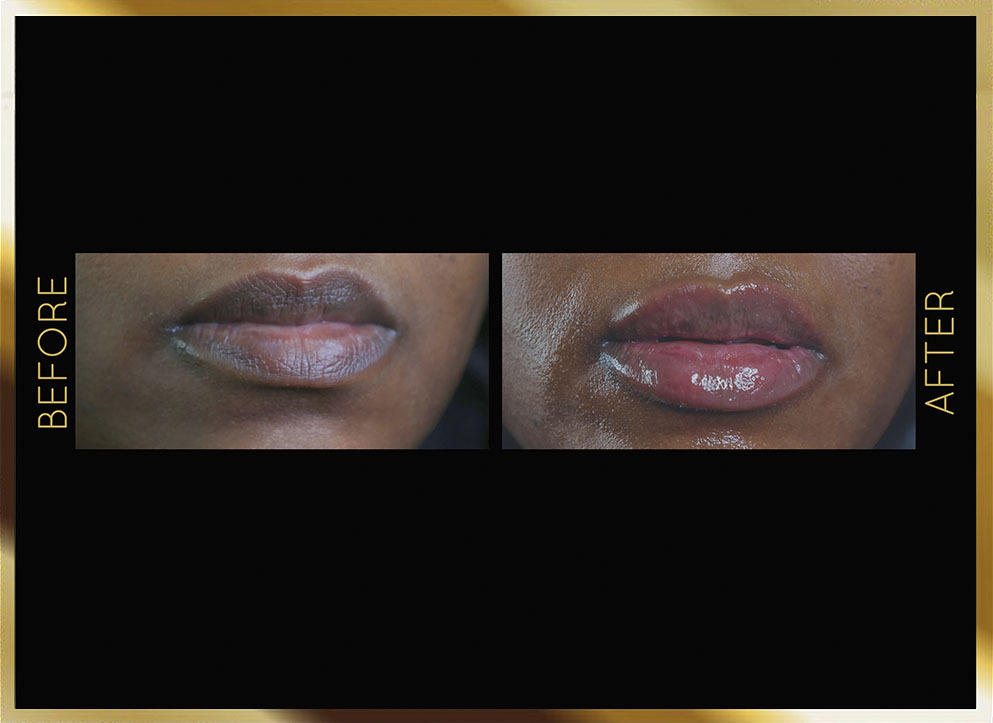 Lip Filler Before and After NYC Case-1 Front