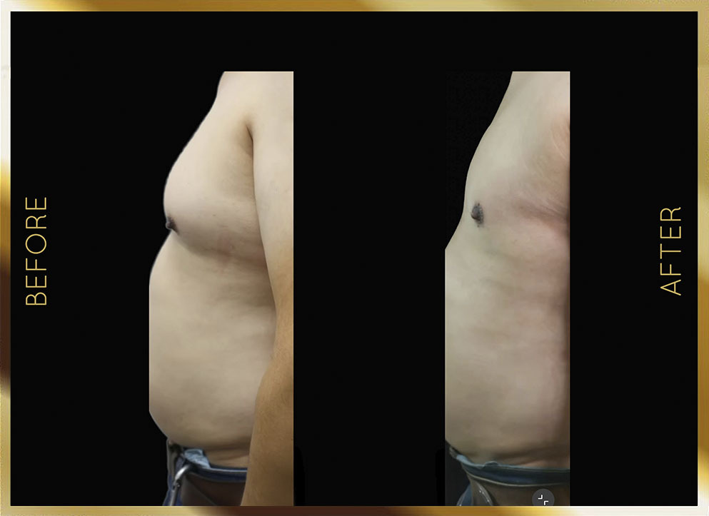 Male Gynecomastia Before and After NYC Case-3