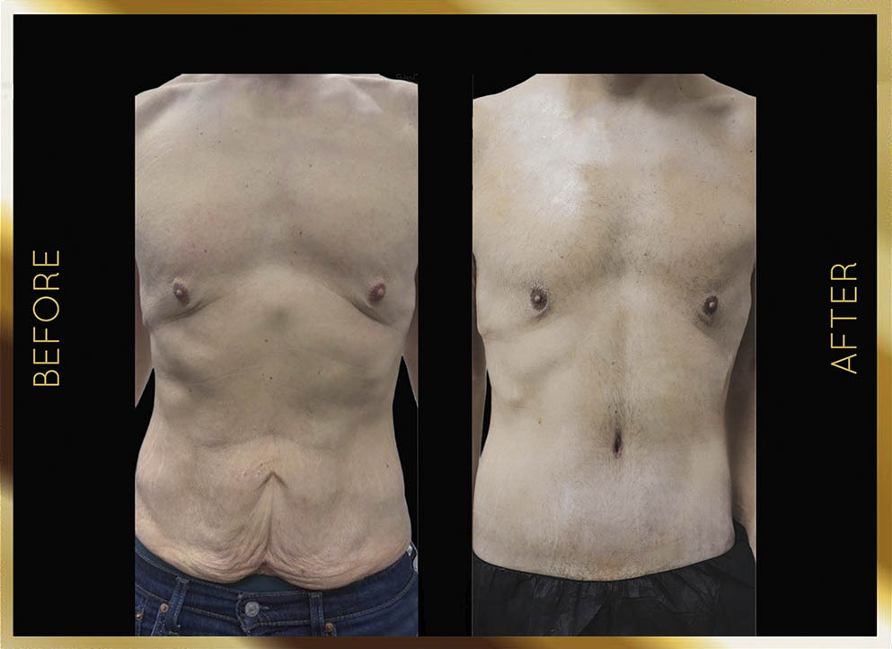Male Tummy Tuck Before & After NYC Case-1