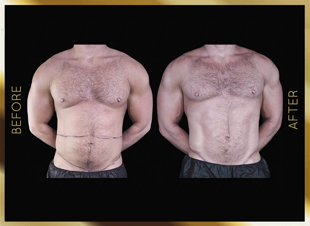 Male Tummy Tuck Before & After NYC Case-2