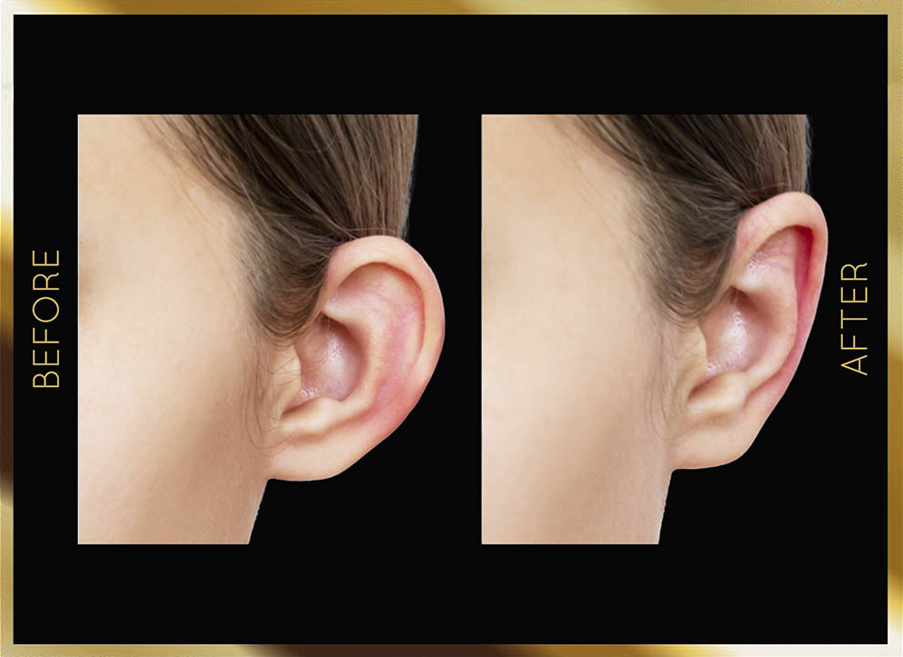 Ear Surgery (Otoplasty) Before & After NYC Case-2