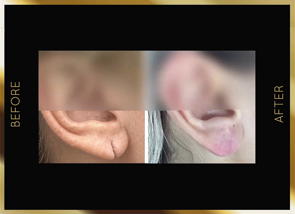 Ear Surgery (Otoplasty) Before & After NYC Case-3