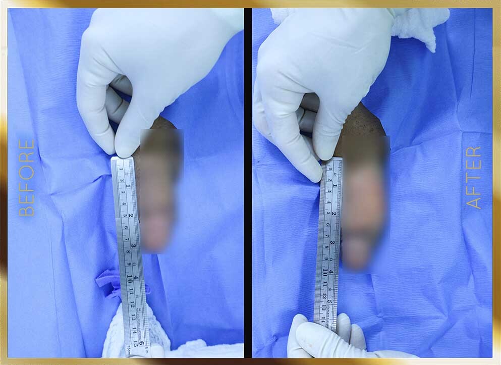 Penile Enhancement Before & After NYC Case-1