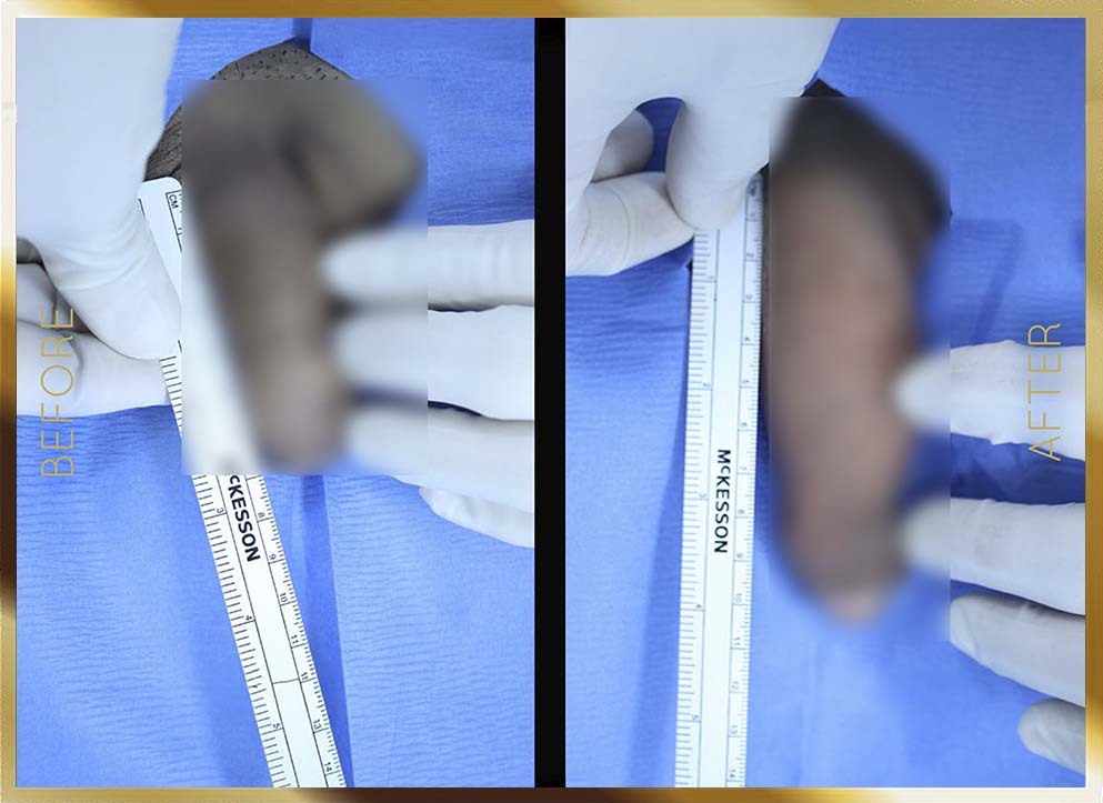 Penile Enhancement Before & After NYC Case-10