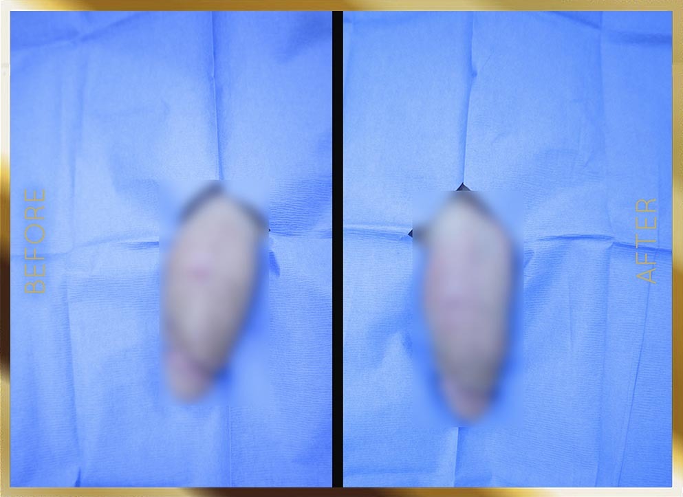 Penile Enhancement Before & After NYC Case-2
