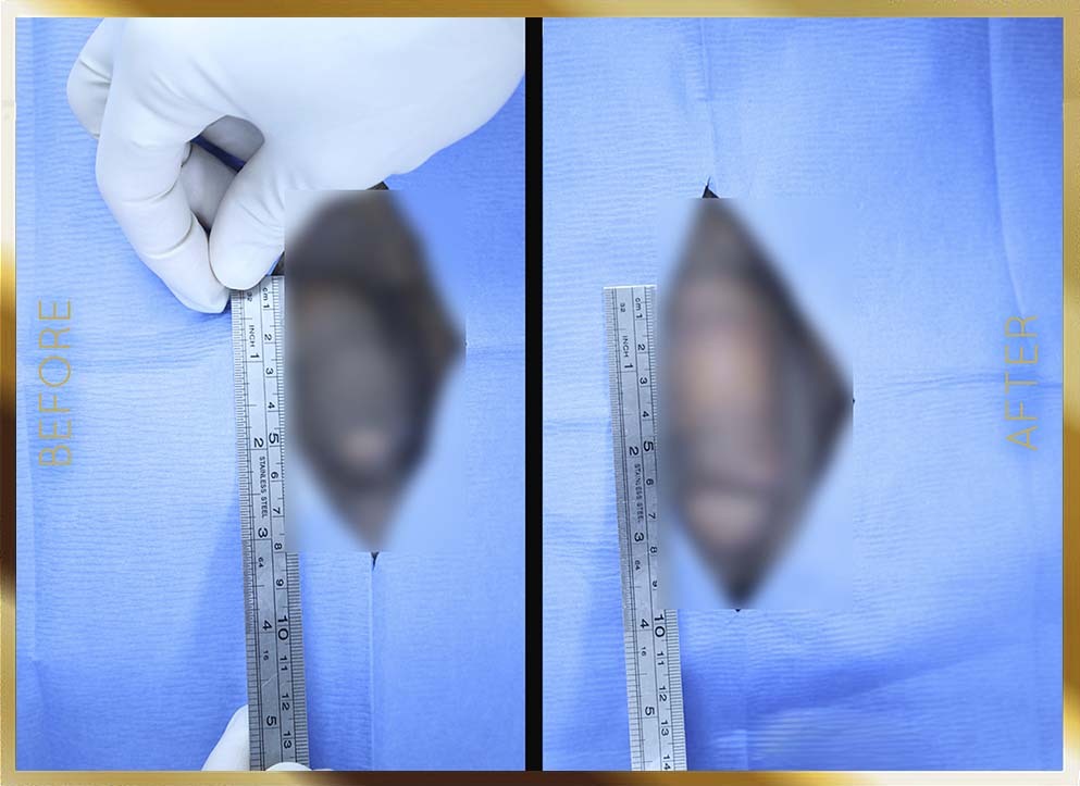 Penile Enhancement Before & After NYC Case-3