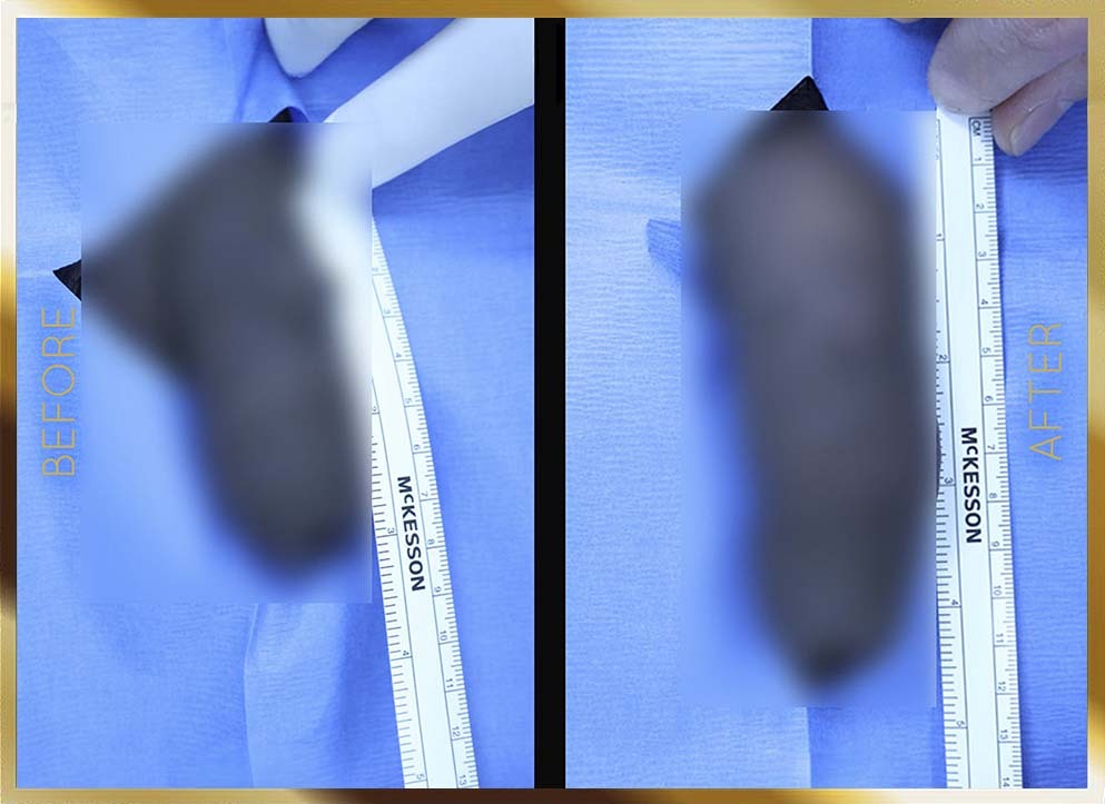 Penile Enhancement Before & After NYC Case-4