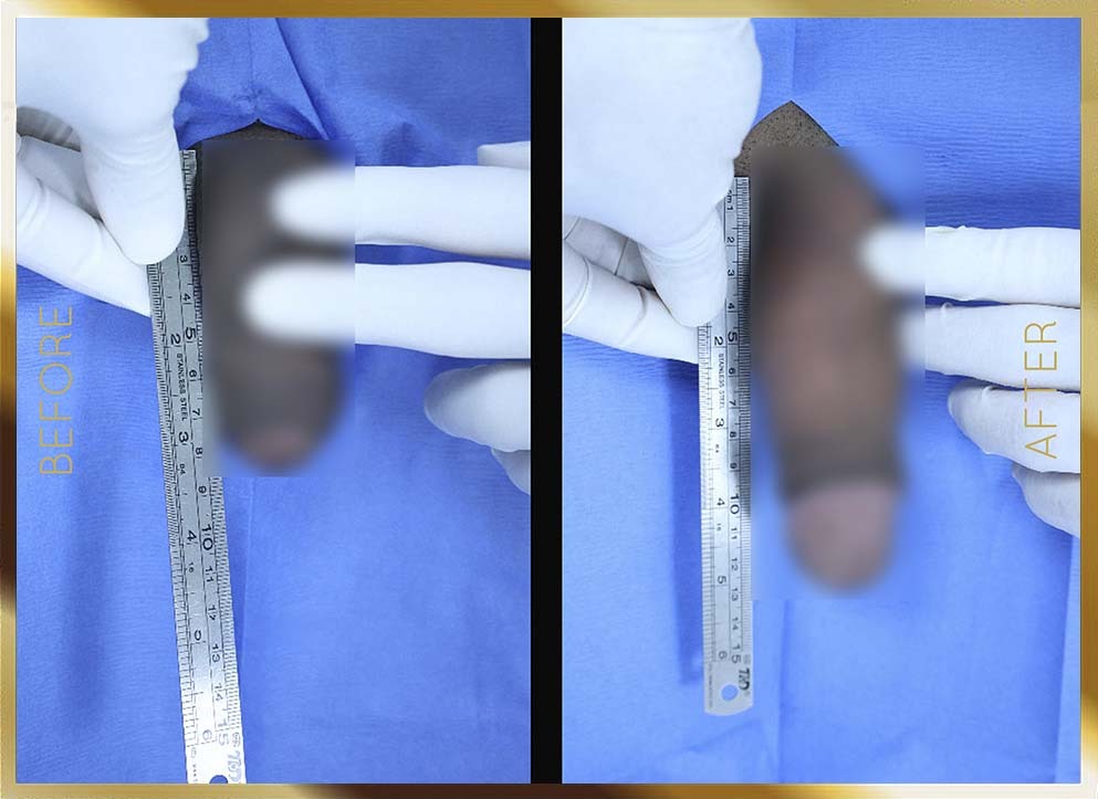 Penile Enhancement Before & After NYC Case-5