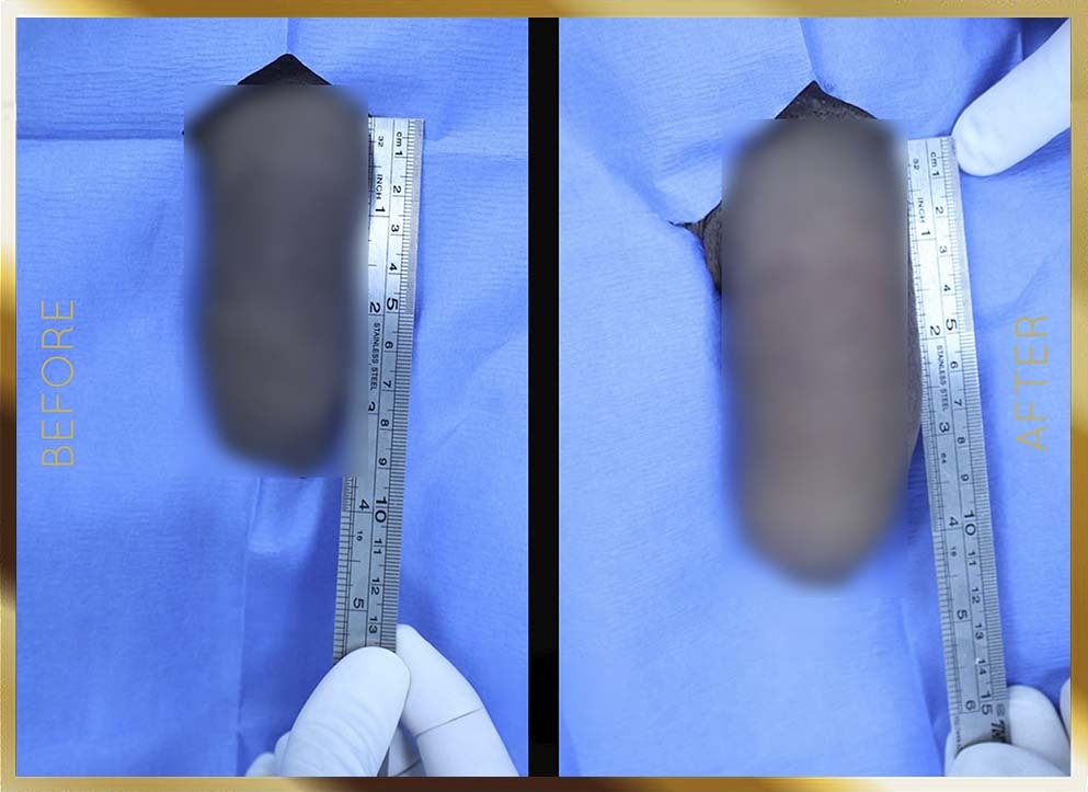 Penile Enhancement Before & After NYC Case-6