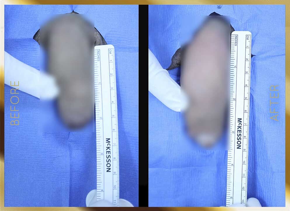 Penile Enhancement Before & After NYC Case-7