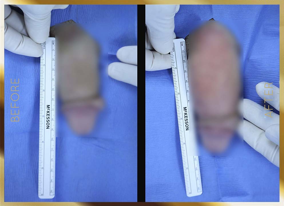 Penile Enhancement Before & After NYC Case-8