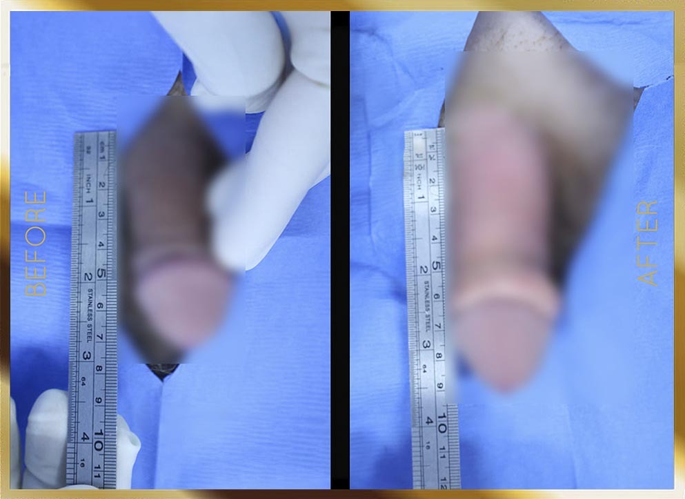 Penile Enhancement Before & After NYC Case-9