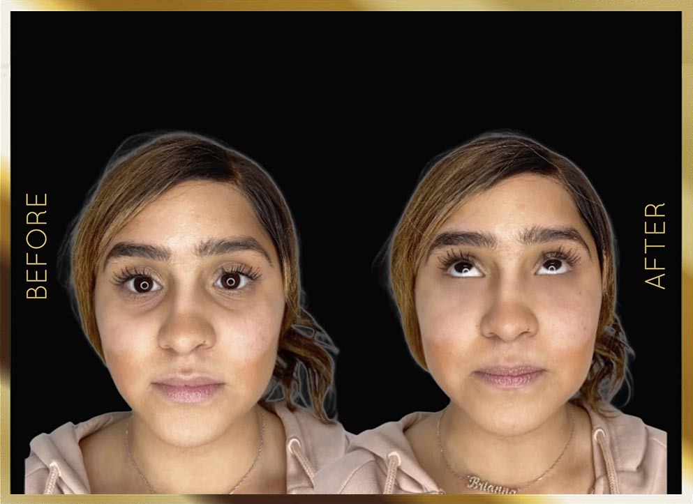 Under Eye Filler Before and After NYC Case-1