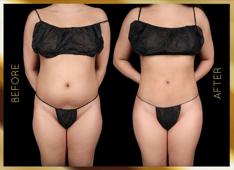 Liposuction Before and After NYC