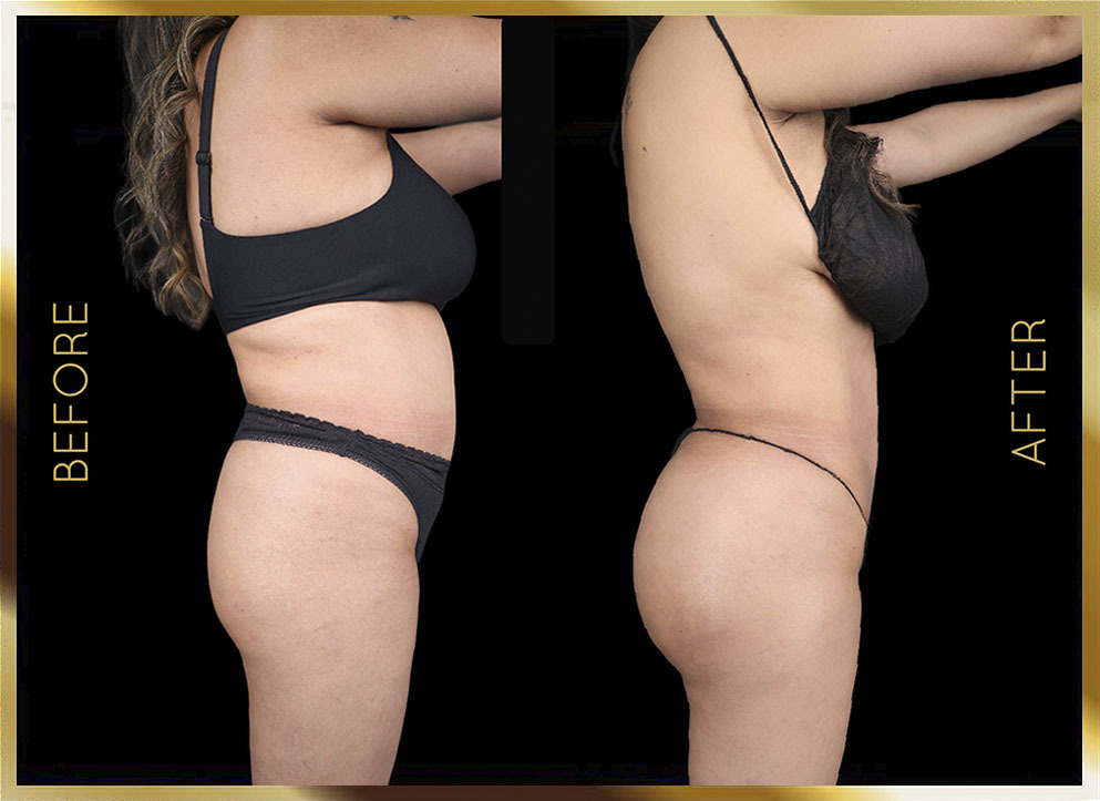 Liposuction Before and After NYC Case-17 Side
