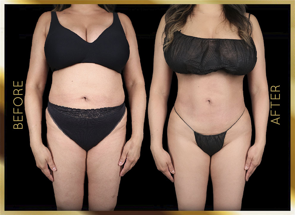 Liposuction Before and After NYC Case-18 Front