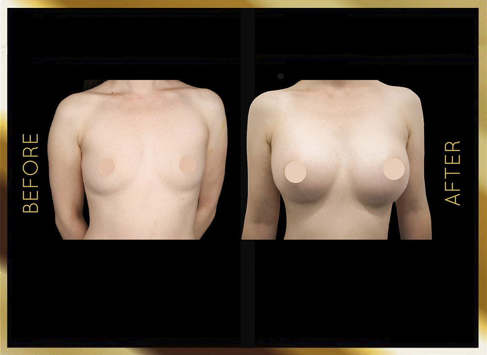 Breast Augmentation Before and After NYC