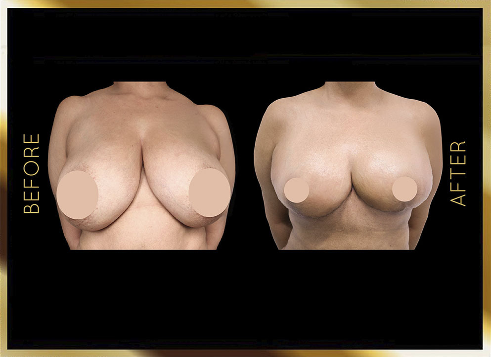 Breast Reduction Before and After NYC