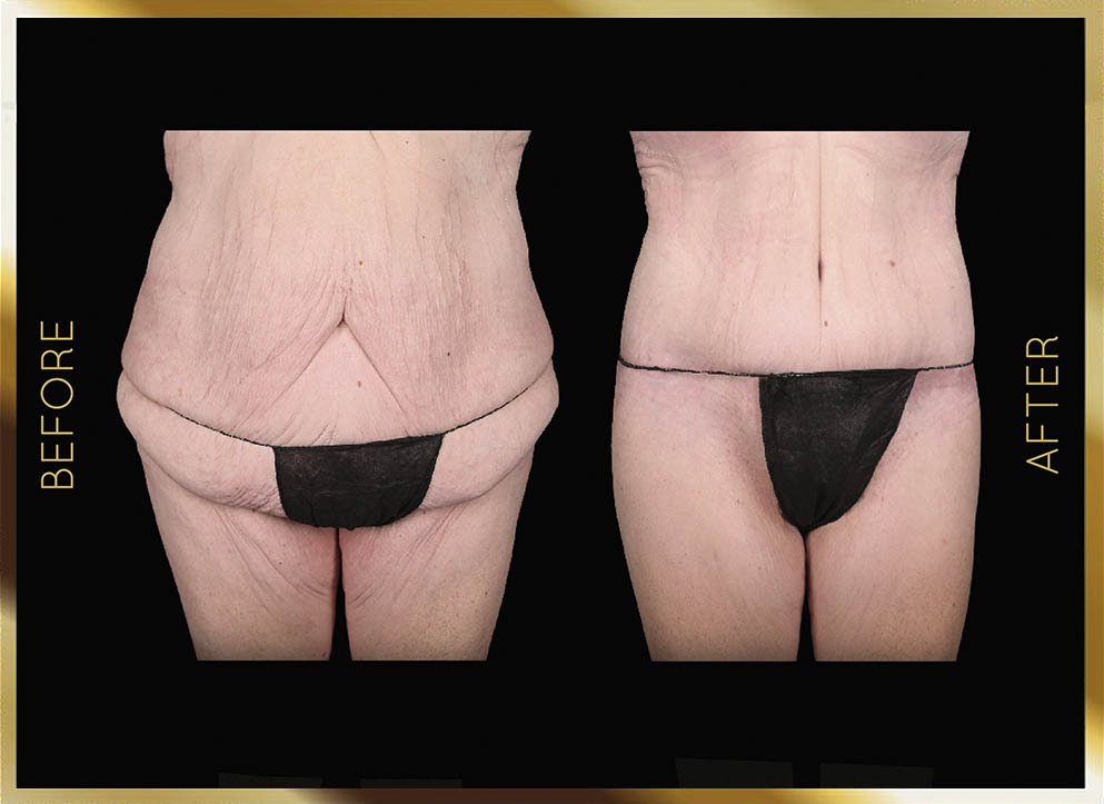 Body Lift in New York City