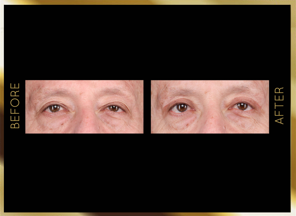 Blepharoplasty Before and After Case 2