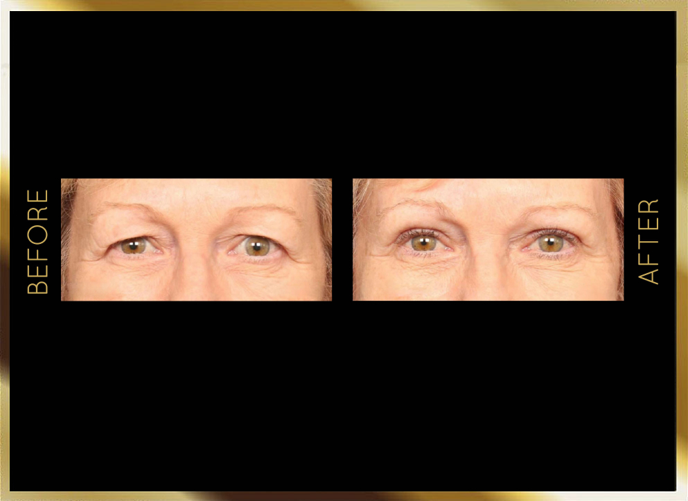 Blepharoplasty Before and After Case 3