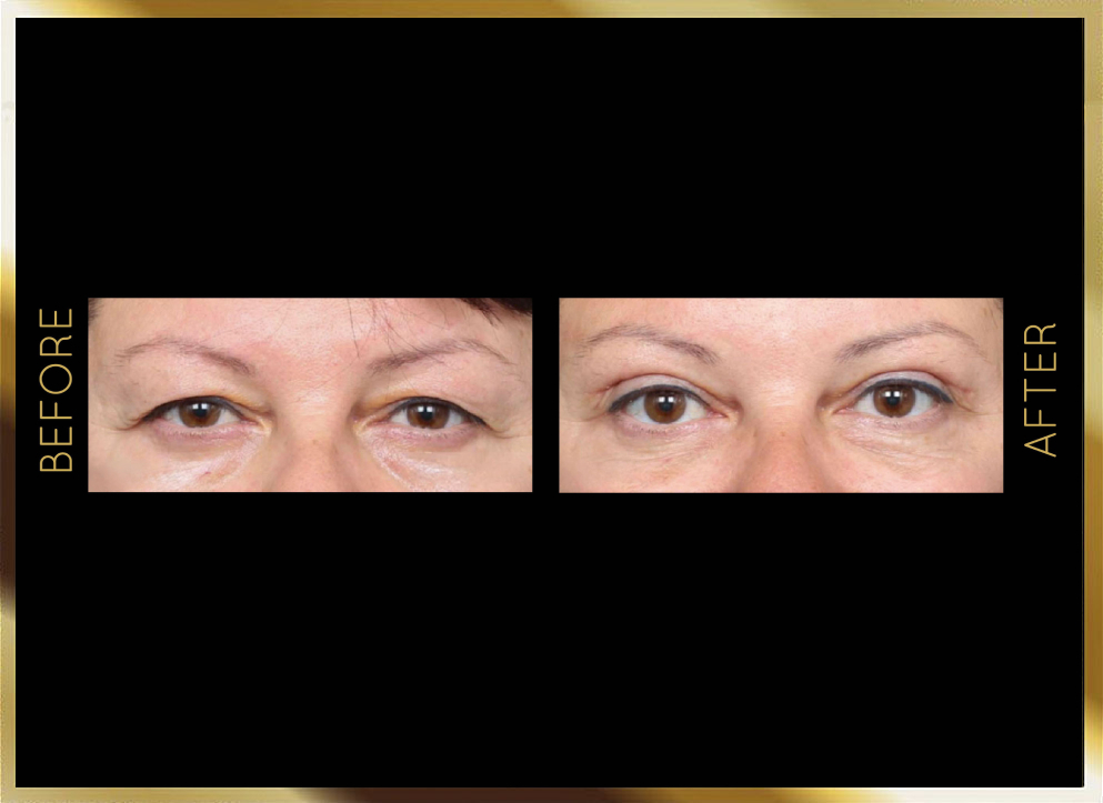 Blepharoplasty Before and After Case 4