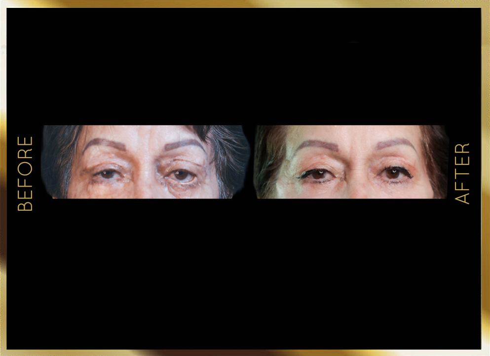 Blepharoplasty Before and After Case 5