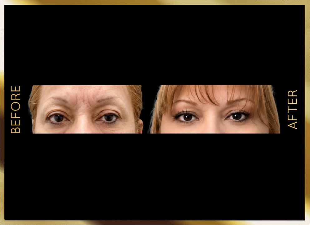 Blepharoplasty Before and After Case 1